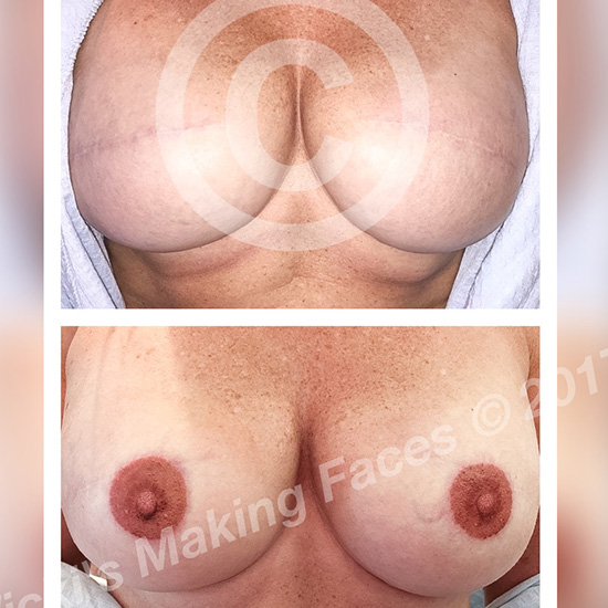 Areola Restoration And 3D Nipple Tattooing 04