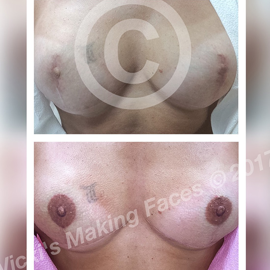 Areola Restoration And 3D Nipple Tattooing 05