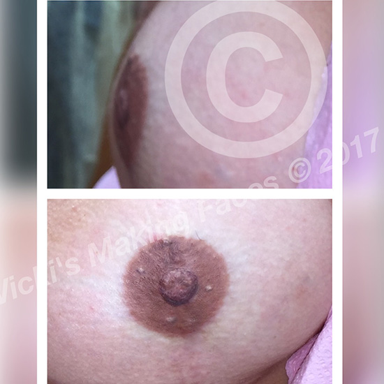 Areola Restoration And 3D Nipple Tattooing 06