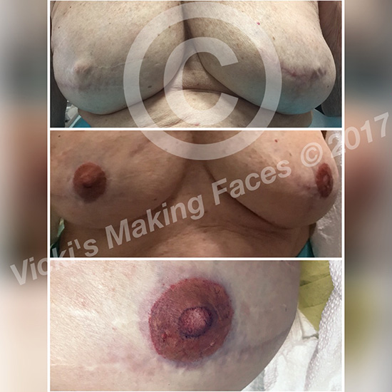 Areola Restoration And 3D Nipple Tattooing 07