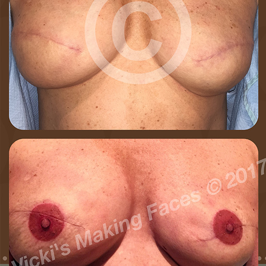 Areola Restoration And 3D Nipple Tattooing 08
