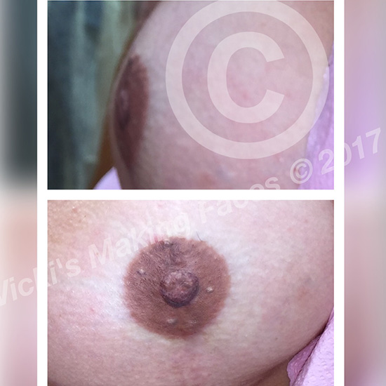 3-D Areola Restoration